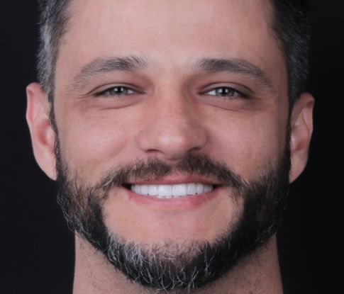 GT Odontologia - Clínica Odontológica em São José do Rio Preto - Lentes em Porcelana