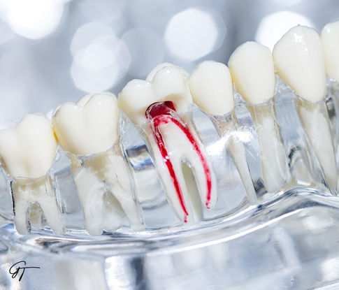 GT Odontologia - Clínica Odontológica em São José do Rio Preto - Endodontia (canal)