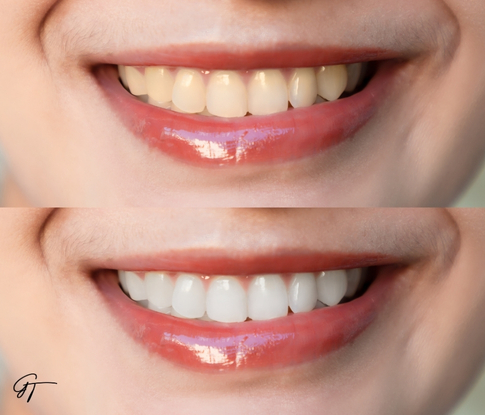 GT Odontologia - Clínica Odontológica em São José do Rio Preto - Clareamento Dental